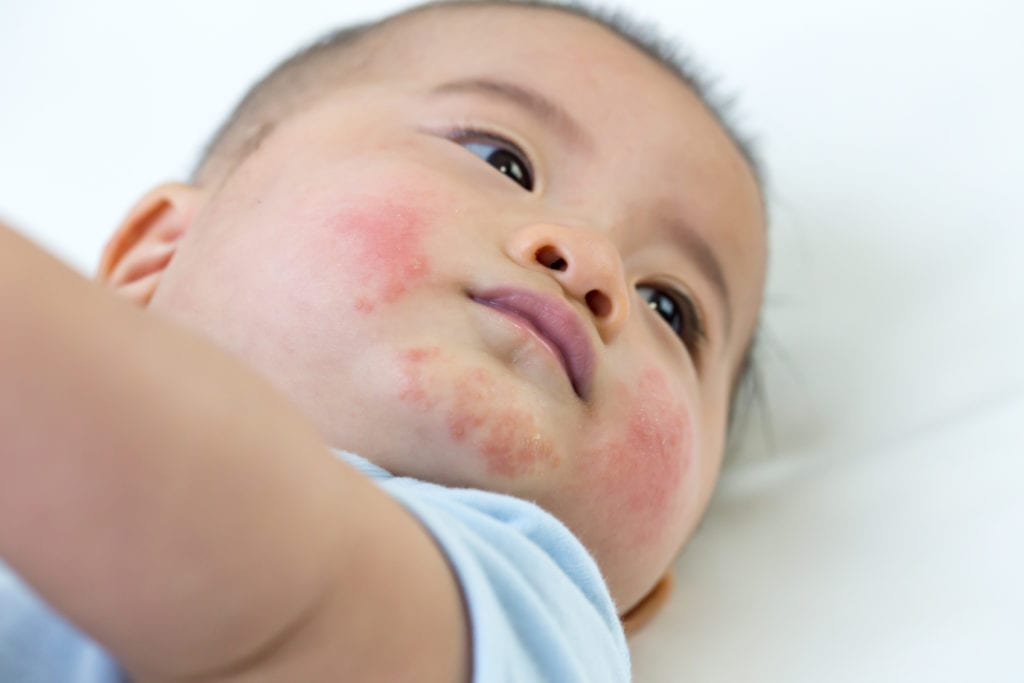 eczema baby