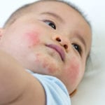 eczema baby